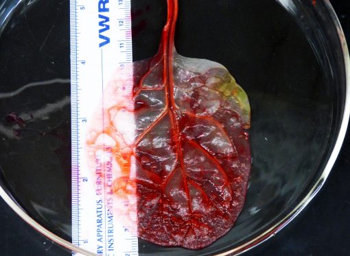 Spinach Leaf Transformed Into Beating Human Heart Tissue