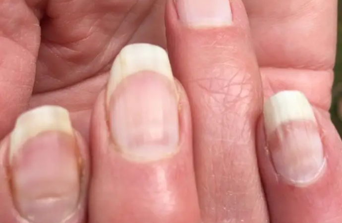 People are getting ‘COVID nails,’ and one expert says the unusual lines could be as useful as an antibody test to prove previous infection